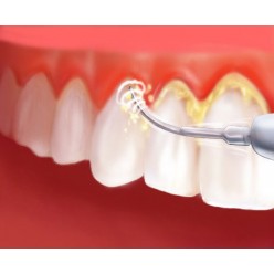 Удаление зубного камня (1 челюсть)